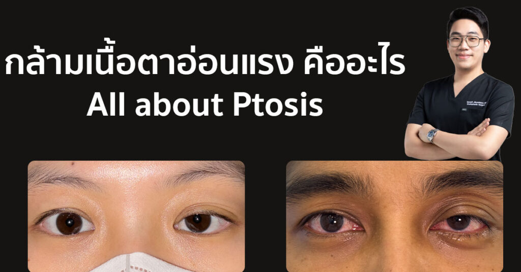Illustration of a patient undergoing ptosis treatment in Bangkok, highlighting advanced surgical techniques to restore vision and enhance appearance