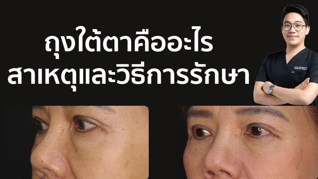 ถุงใต้ตา