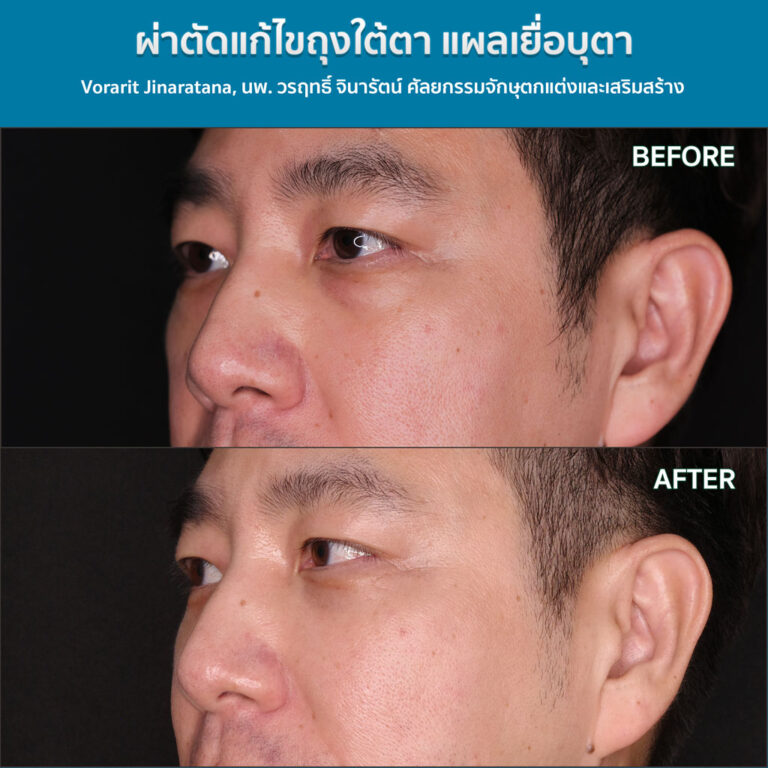 ภาพรีวิวก่อนและหลังผ่าตัดถุงใต้ตาและหนังตาล่าง โดย นพ.วรฤทธิ์ จินารัตน์ เปลี่ยนใต้ตาที่ดูบวมและมีริ้วรอยให้กลับมาเรียบเนียน