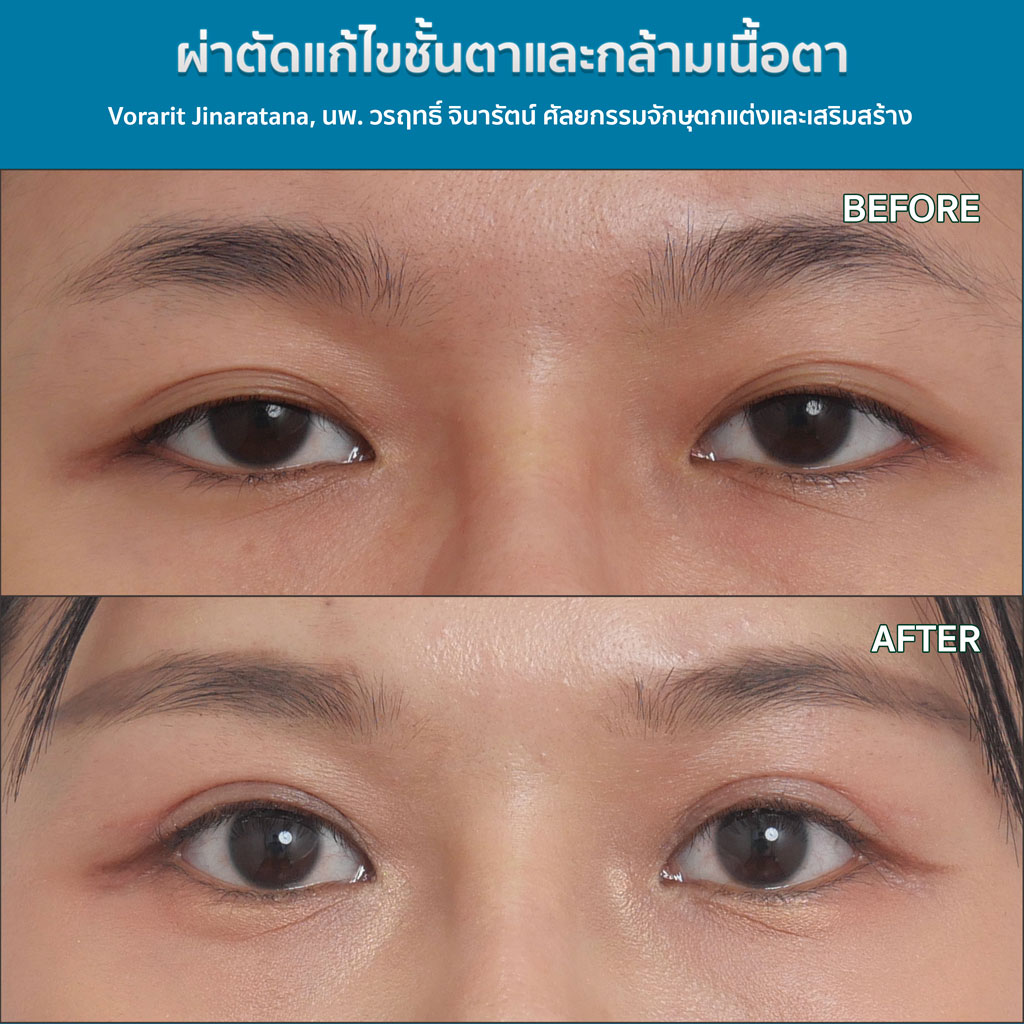 แก้ไขกล้ามเนื้อตา