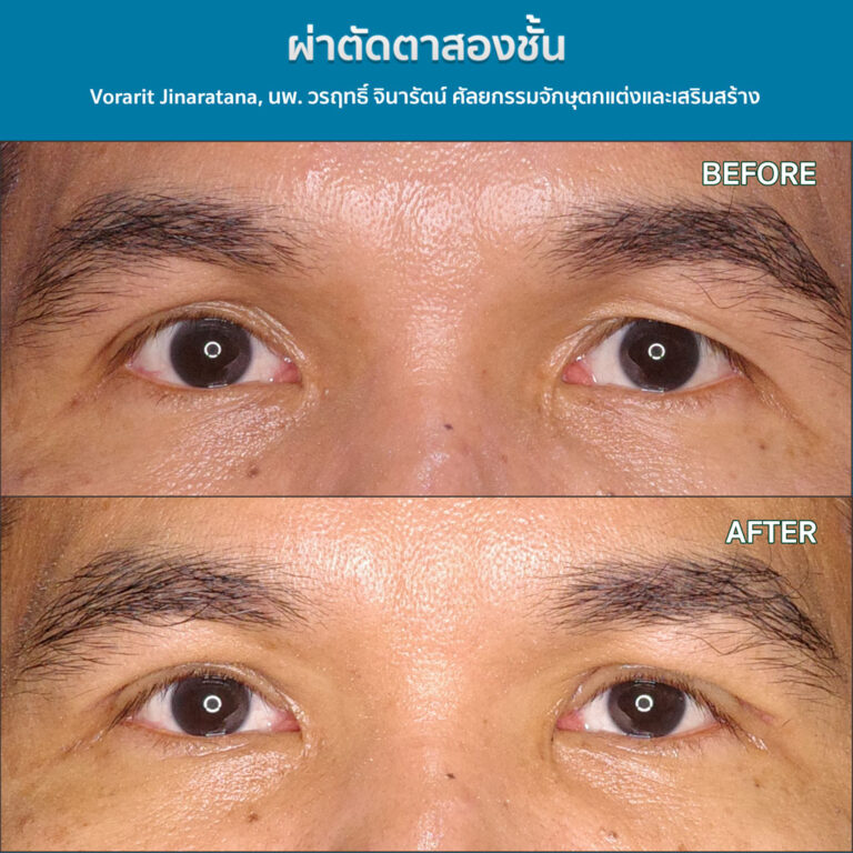 ภาพเปรียบเทียบก่อนและหลังการทำตาสองชั้น โดย นพ.วรฤทธิ์ จินารัตน์ เปลี่ยนตาชั้นเดียวให้มีชั้นตาที่คมชัด สวยงามเป็นธรรมชาติ