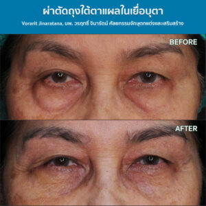 ถุงใต้ตาหลังการศัลยกรรม