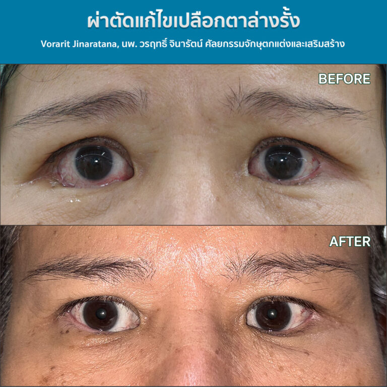 ภาพเปรียบเทียบก่อนและหลังการผ่าตัดแก้ไขภาวะเปลือกตาล่างรั้งลง (Lower Eyelid Retraction) ที่ทำให้เห็นตาขาวเยอะผิดปกติ โดย นพ.วรฤทธิ์ จินารัตน์