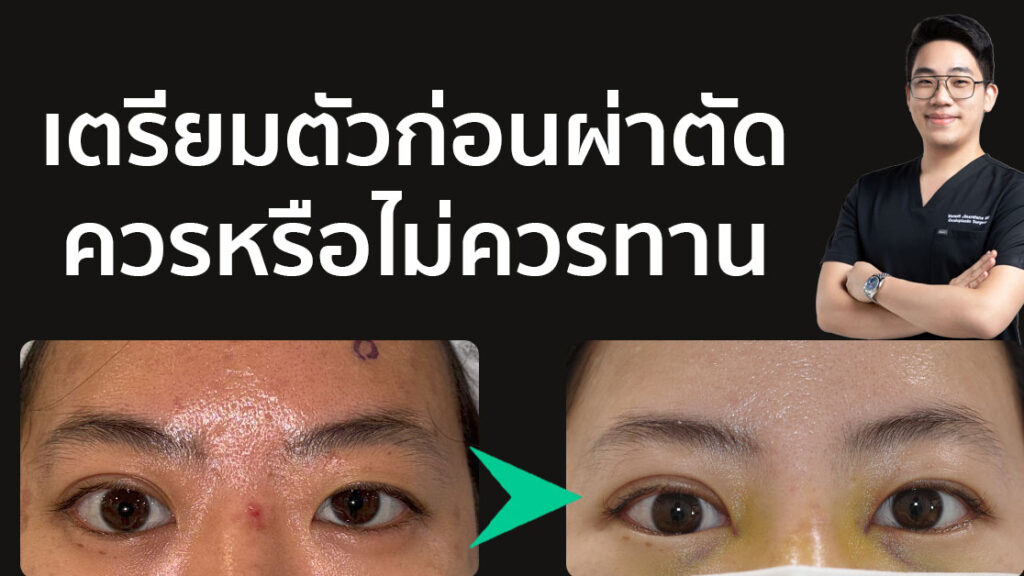 เตรียมตัวก่อนผ่าตัด