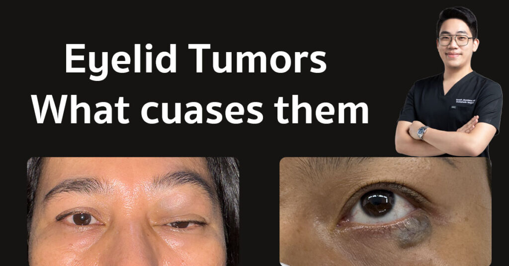 eyelid tumors