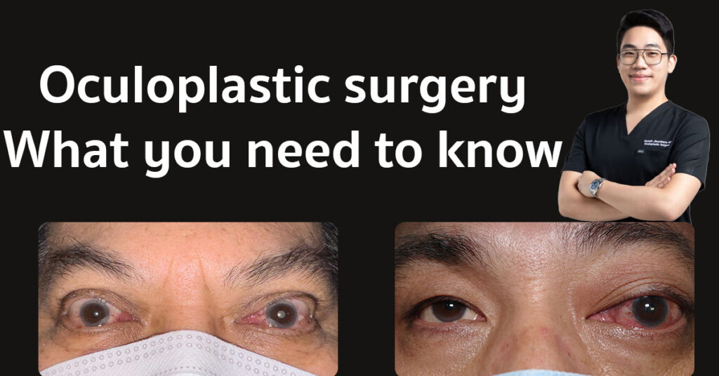 oculoplastic