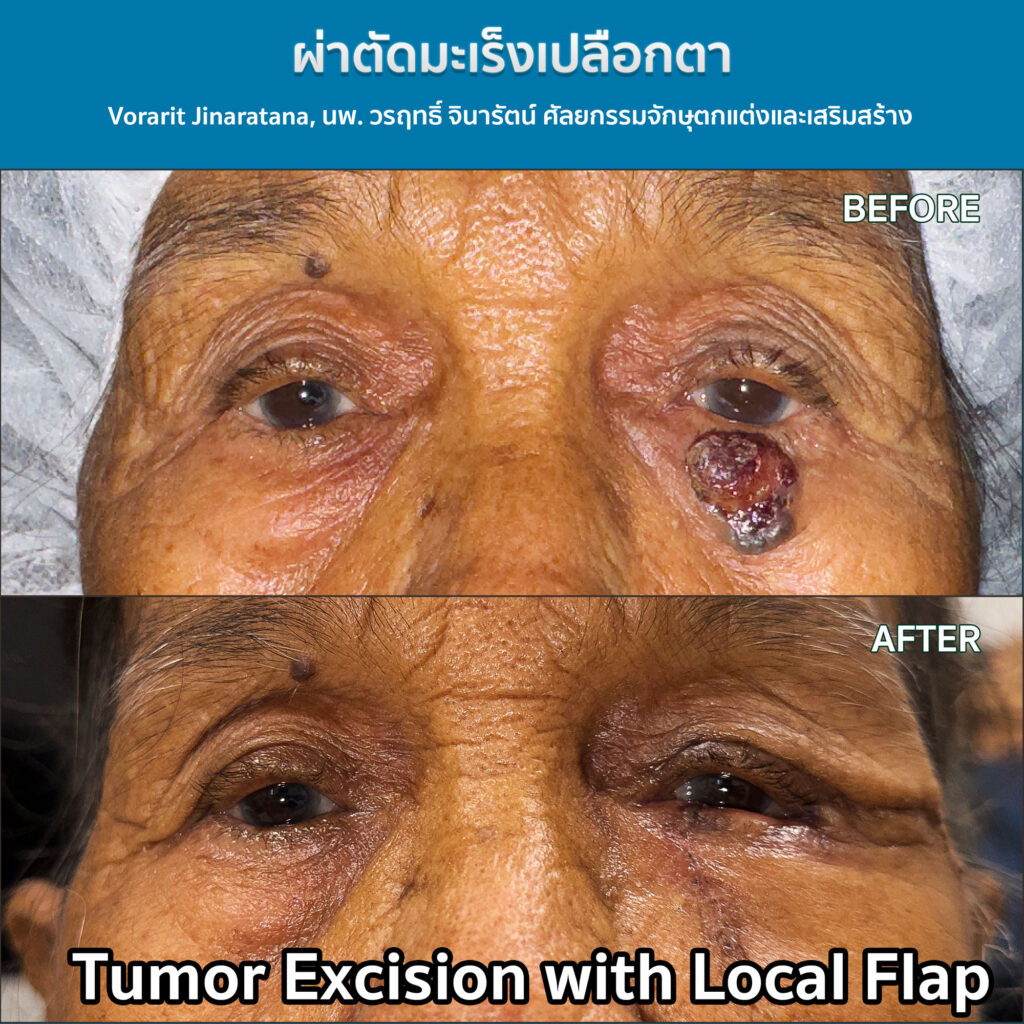 ผ่าตัดมะเร็งเปลือกตา