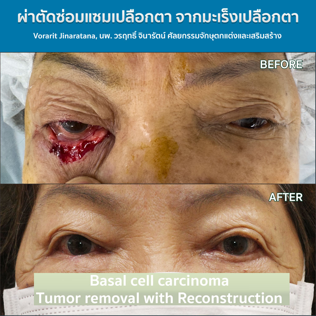 ผ่าตัดมะเร็งเปลือกตา