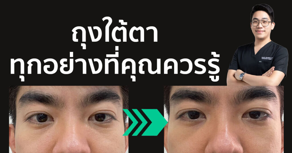 ถุงใต้ตา