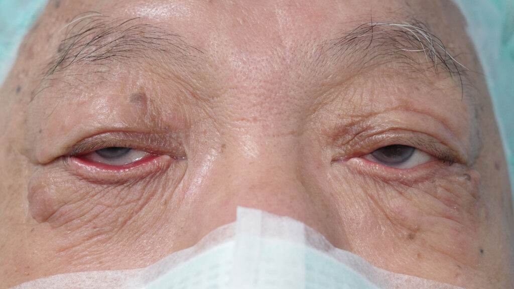 Ectropion Right lower eyelid