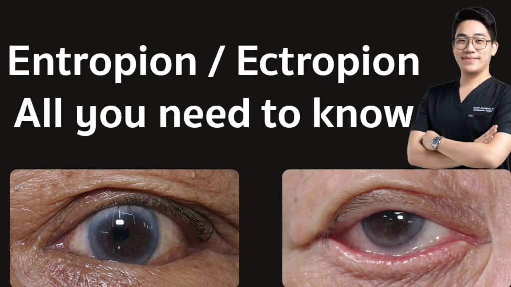 Entropion and ectropion