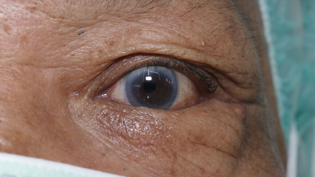 Entropion Left lower eyelid