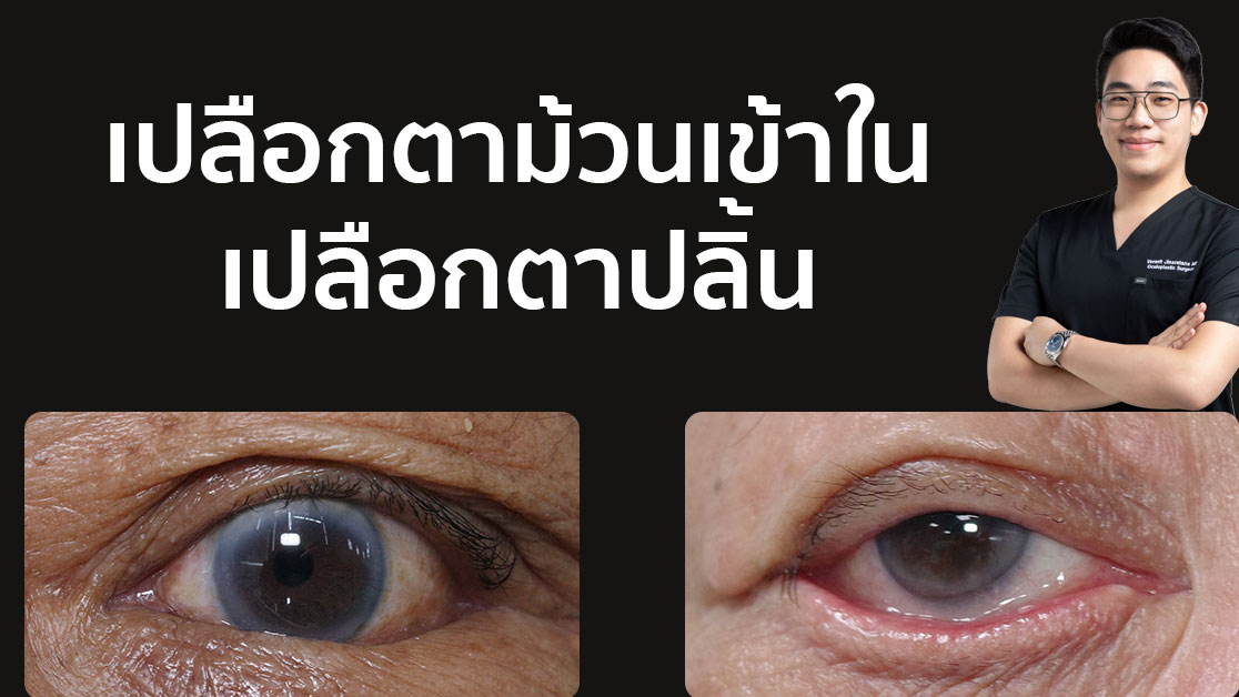 เปลือกตาม้วนเข้าใน