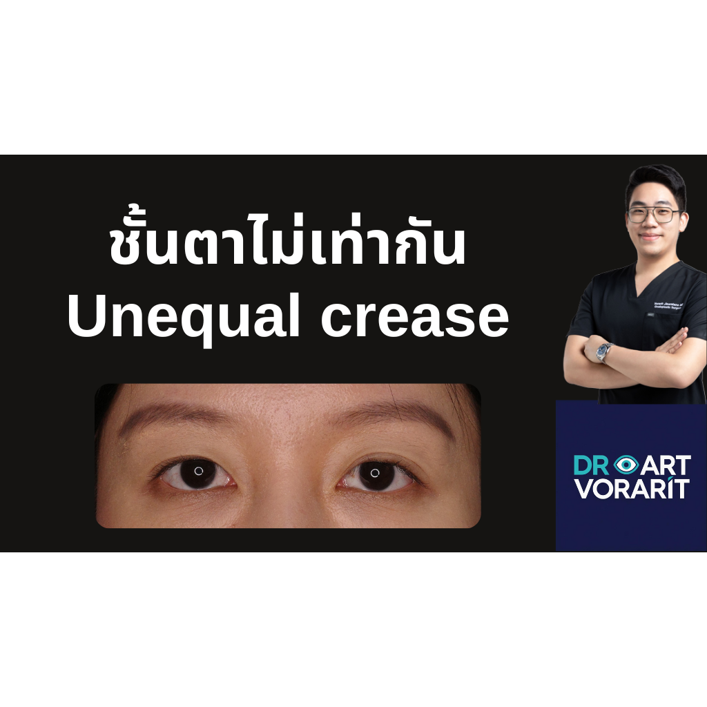 ชั้นตาไม่เท่ากัน