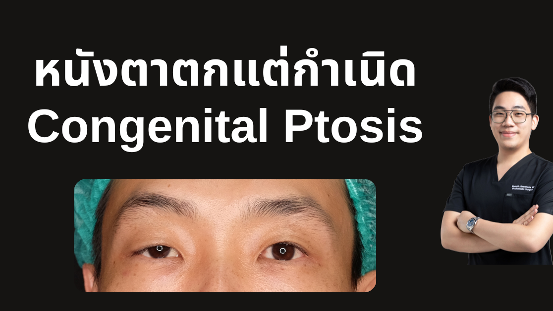 ภาพการผ่าตัดหนังตาตกแต่กำเนิด