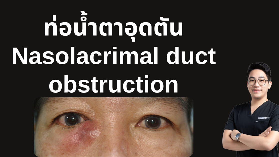 Nasolacrimal duct obstruction