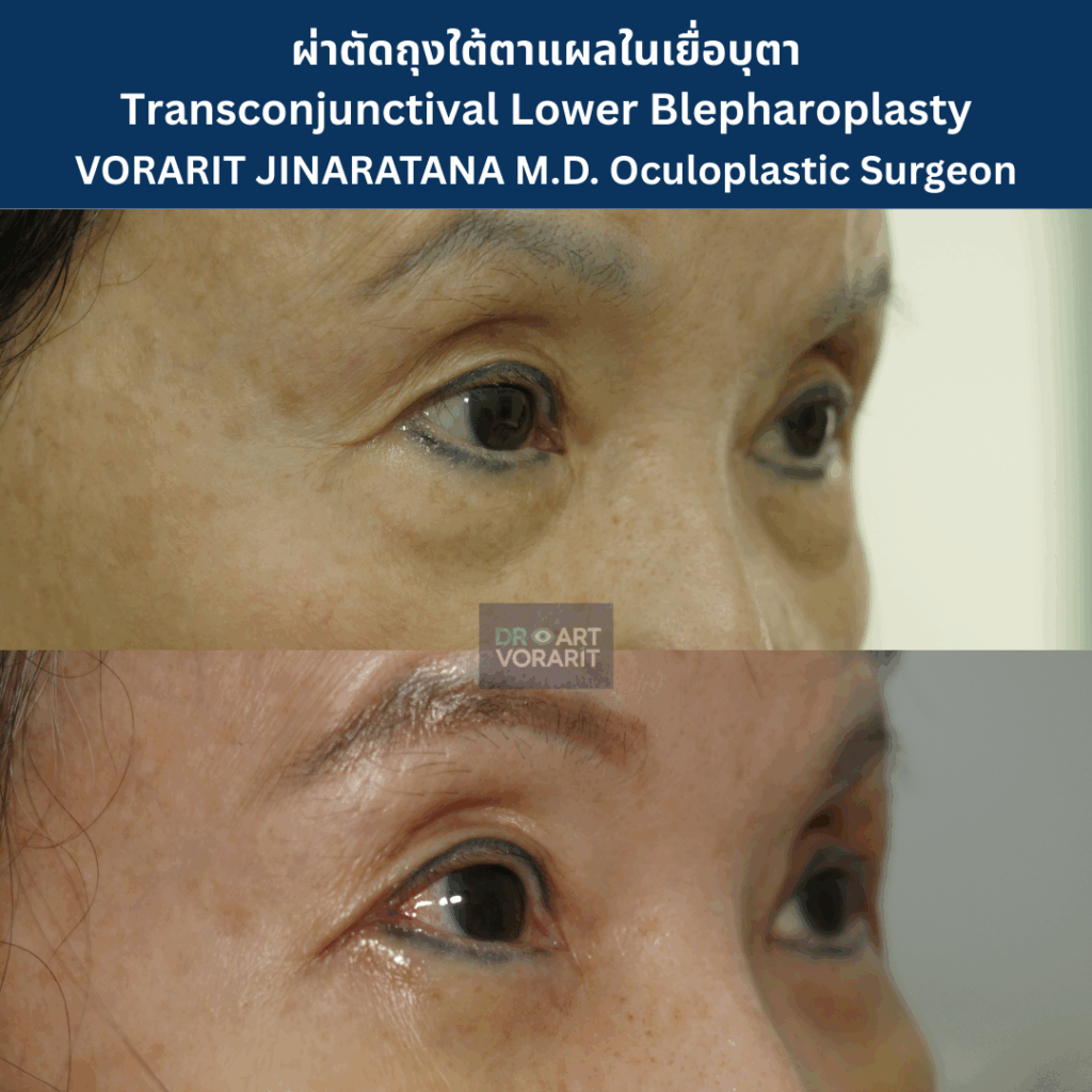 ภาพรีวิวก่อนและหลังการผ่าตัดถุงใต้ตาและเก็บหนังตาส่วนเกินที่เปลือกตาล่าง ทำให้ใต้ตาที่หย่อนคล้อยกลับมาเรียบเนียน โดย นพ.วรฤทธิ์ จินารัตน์