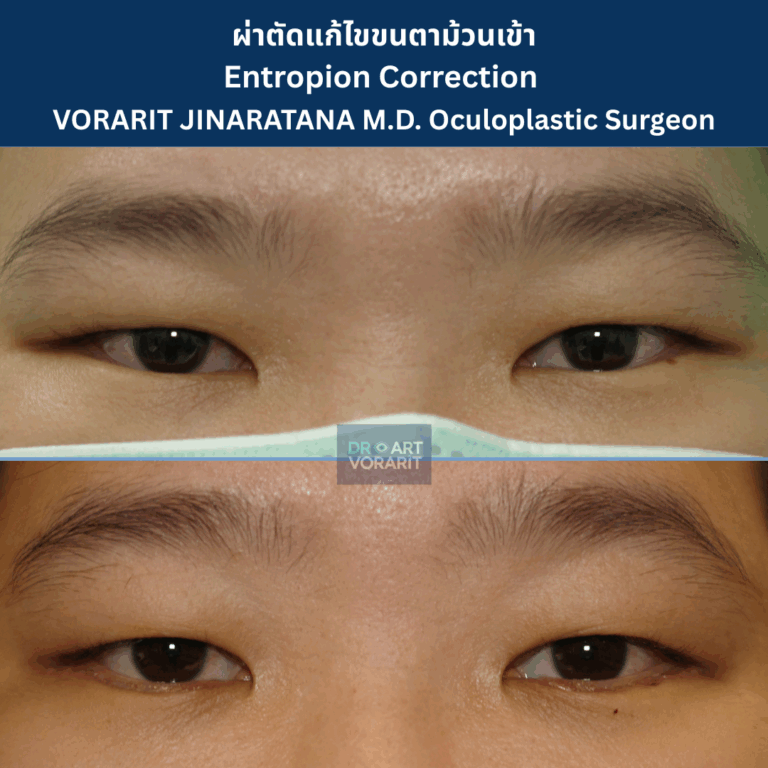 ภาพเปรียบเทียบก่อนและหลังการผ่าตัดแก้ไขภาวะเปลือกตาล่างม้วนเข้า (Entropion) ซึ่งเป็นสาเหตุของขนตาทิ่มตา โดย นพ.วรฤทธิ์ จินารัตน์