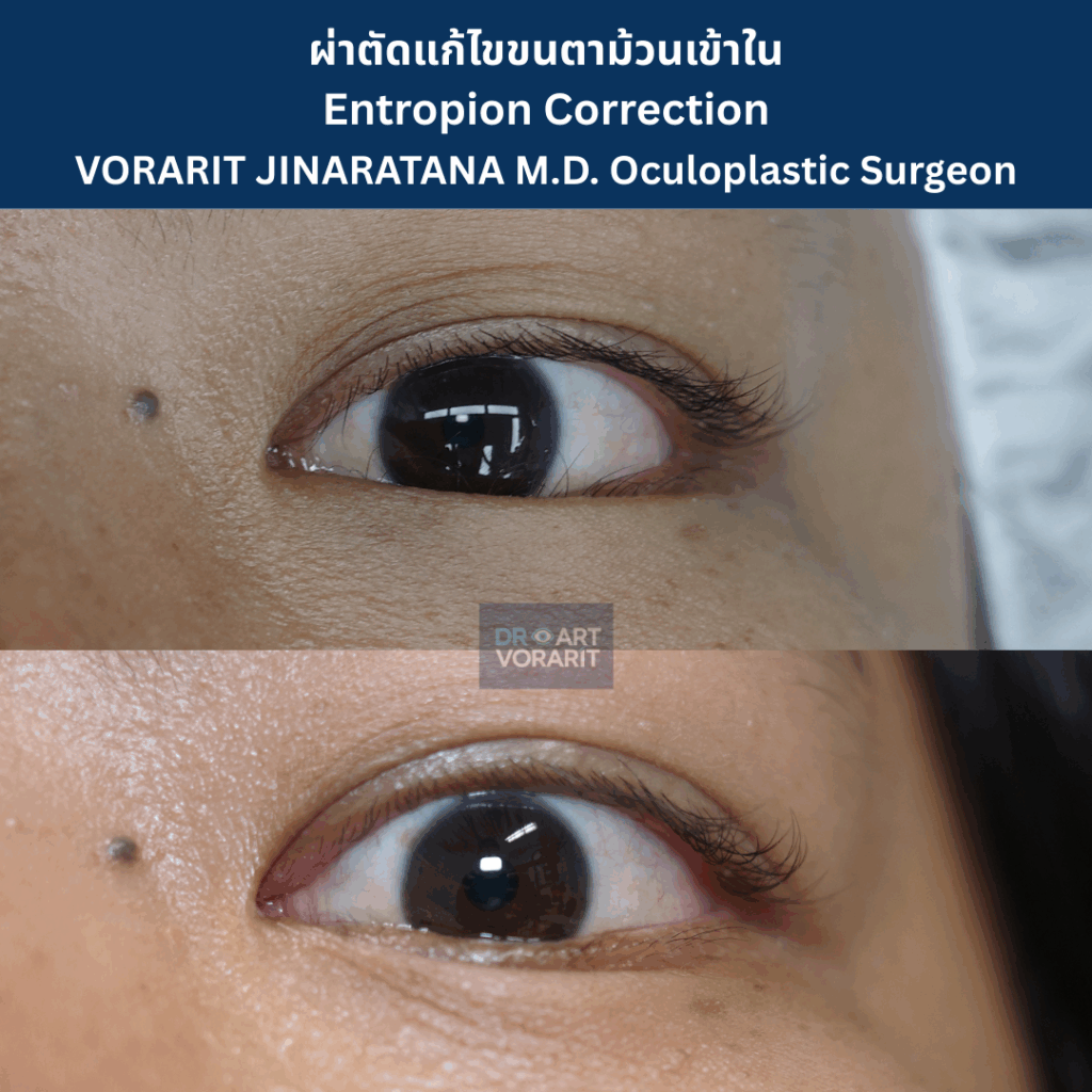 ภาพเปรียบเทียบก่อนและหลังการผ่าตัดแก้ไขภาวะเปลือกตาล่างม้วนเข้า (Entropion) ซึ่งเป็นสาเหตุของขนตาทิ่มตา โดย นพ.วรฤทธิ์ จินารัตน์