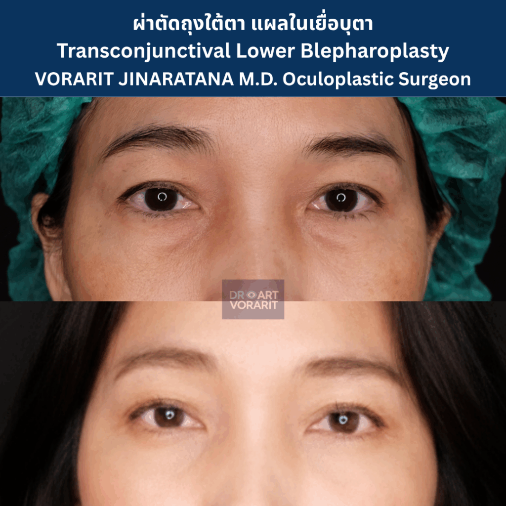 ภาพรีวิวก่อนและหลังการผ่าตัดถุงใต้ตาและเก็บหนังตาส่วนเกินที่เปลือกตาล่าง ทำให้ใต้ตาที่หย่อนคล้อยกลับมาเรียบเนียน โดย นพ.วรฤทธิ์ จินารัตน์