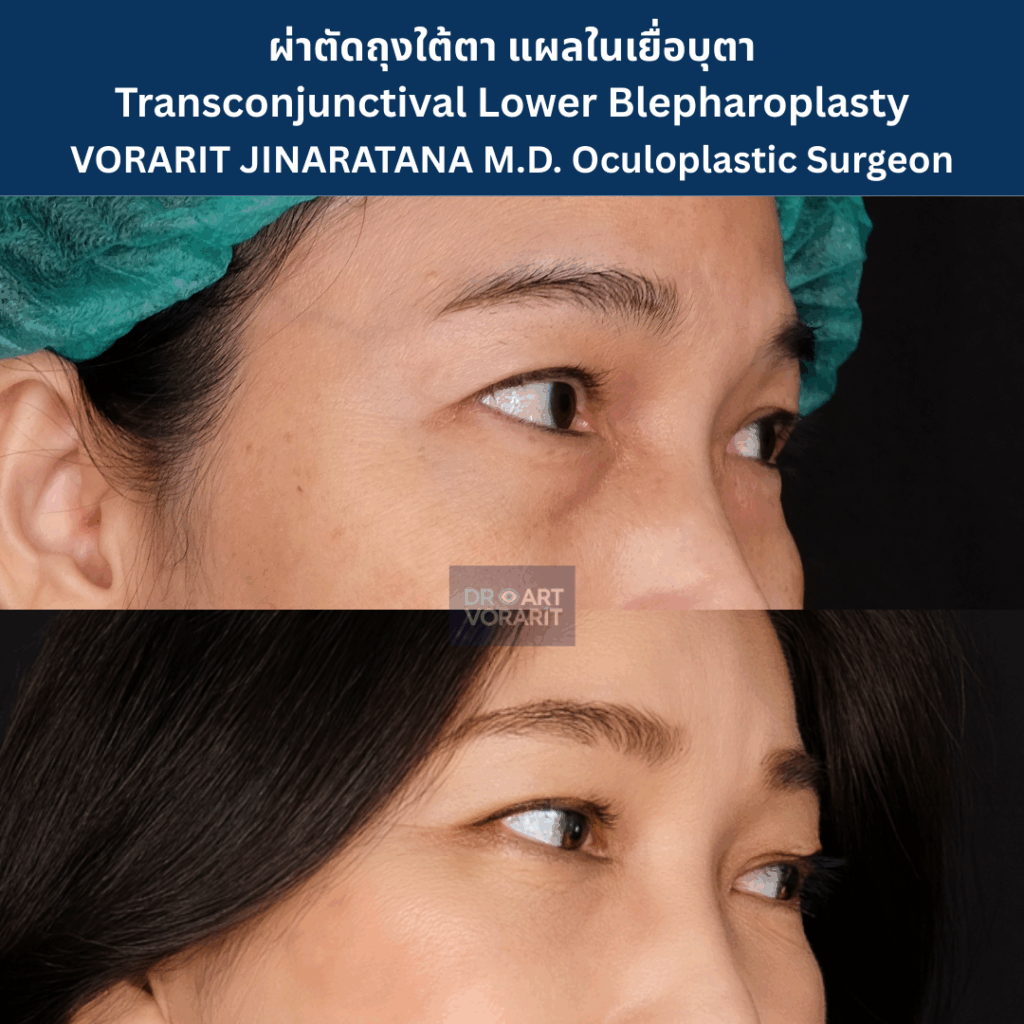 ภาพรีวิวก่อนและหลังการผ่าตัดถุงใต้ตาและเก็บหนังตาส่วนเกินที่เปลือกตาล่าง ทำให้ใต้ตาที่หย่อนคล้อยกลับมาเรียบเนียน โดย นพ.วรฤทธิ์ จินารัตน์