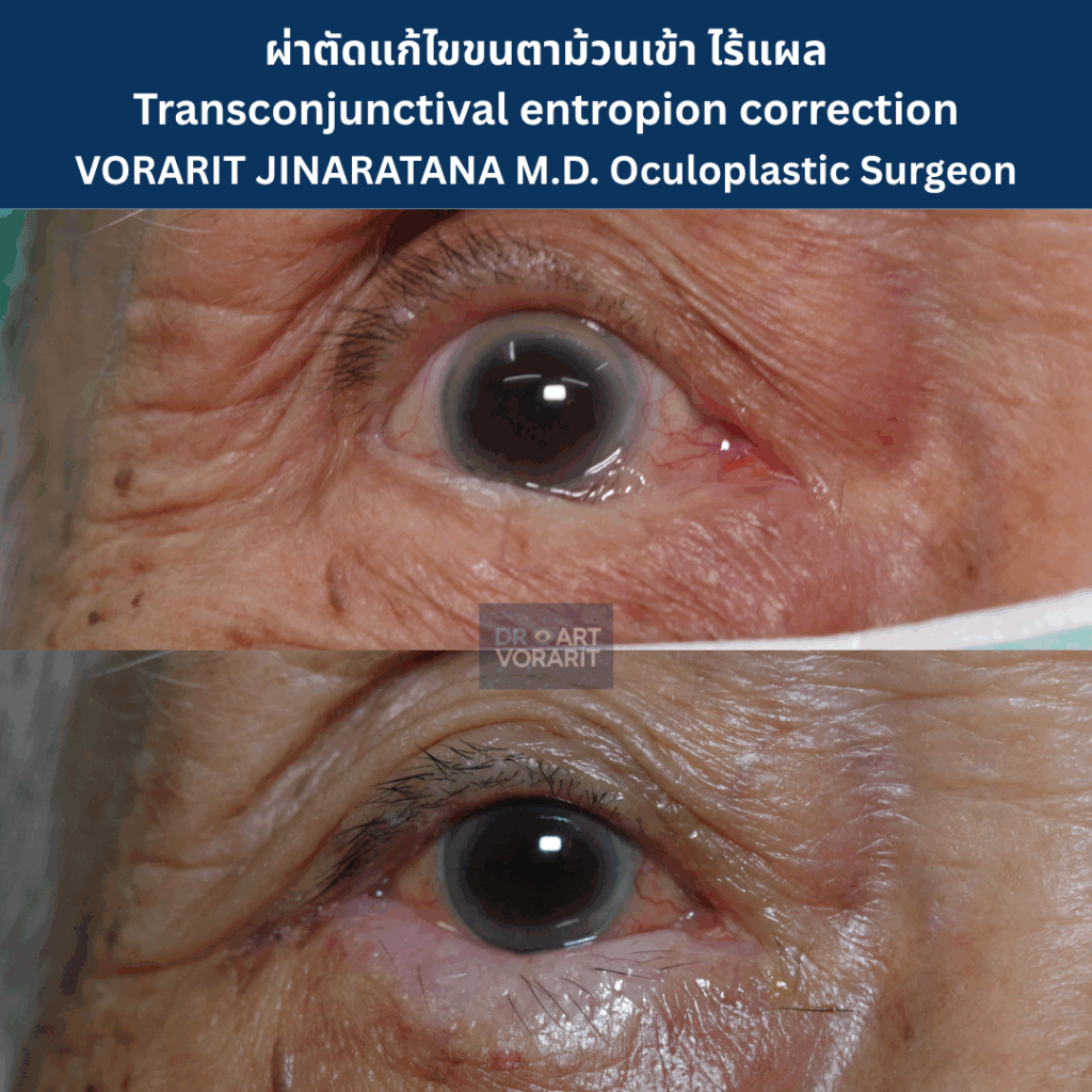 ภาพเปรียบเทียบ ก่อน-หลัง ผ่าตัดแก้ไขขนตาม้วนเข้า แบบซ่อนแผล (Transconjunctival Entropion Correction) โดย นพ.วรฤทธิ์ จินารัตน์