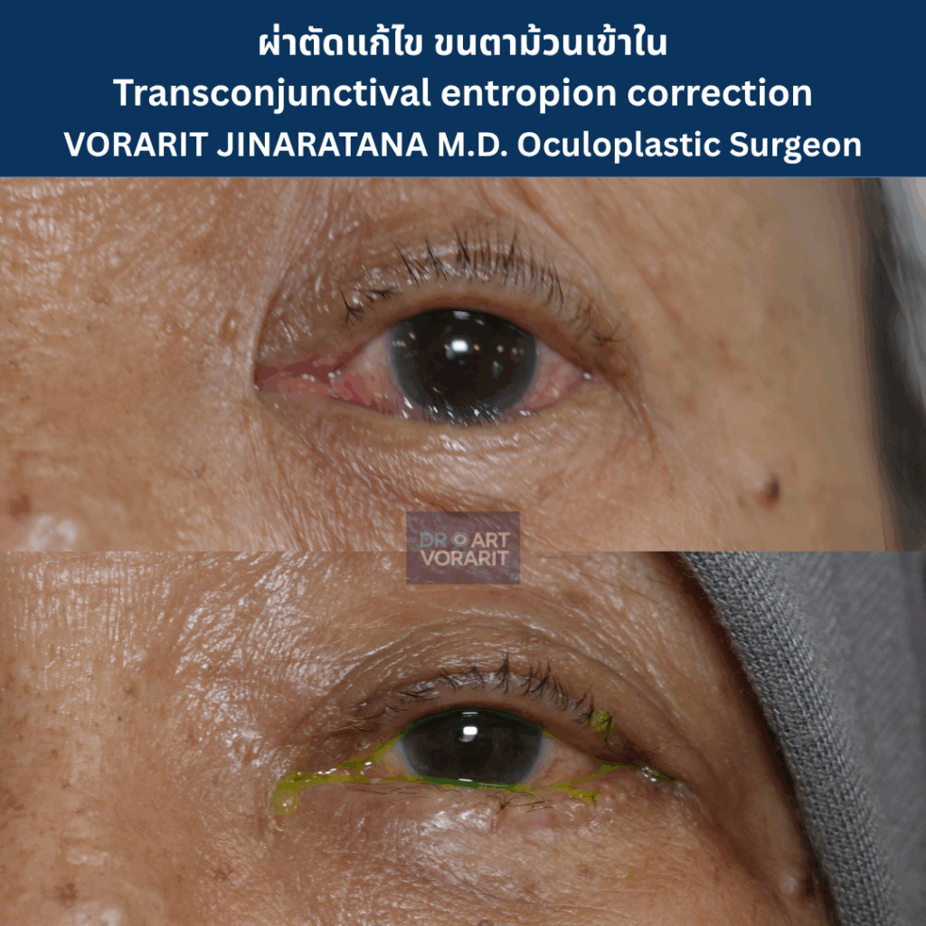 รูปก่อนและหลังผ่าตัด ภาวะขนตาม้วนเข้าใน (Entropion) ที่ทำให้เกิดการระคายเคืองตา โดยจักษุแพทย์ นพ.วรฤทธิ์ จินารัตน์
