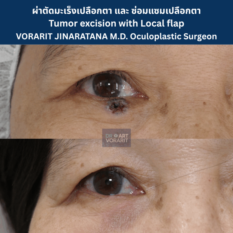 ภาพเปรียบเทียบก่อนและหลังการผ่าตัดเนื้องอก (Tumor) ออกจากเปลือกตาอย่างหมดจด พร้อมเสริมสร้างเปลือกตาให้กลับมาเรียบเนียน โดย นพ.วรฤทธิ์ จินารัตน์