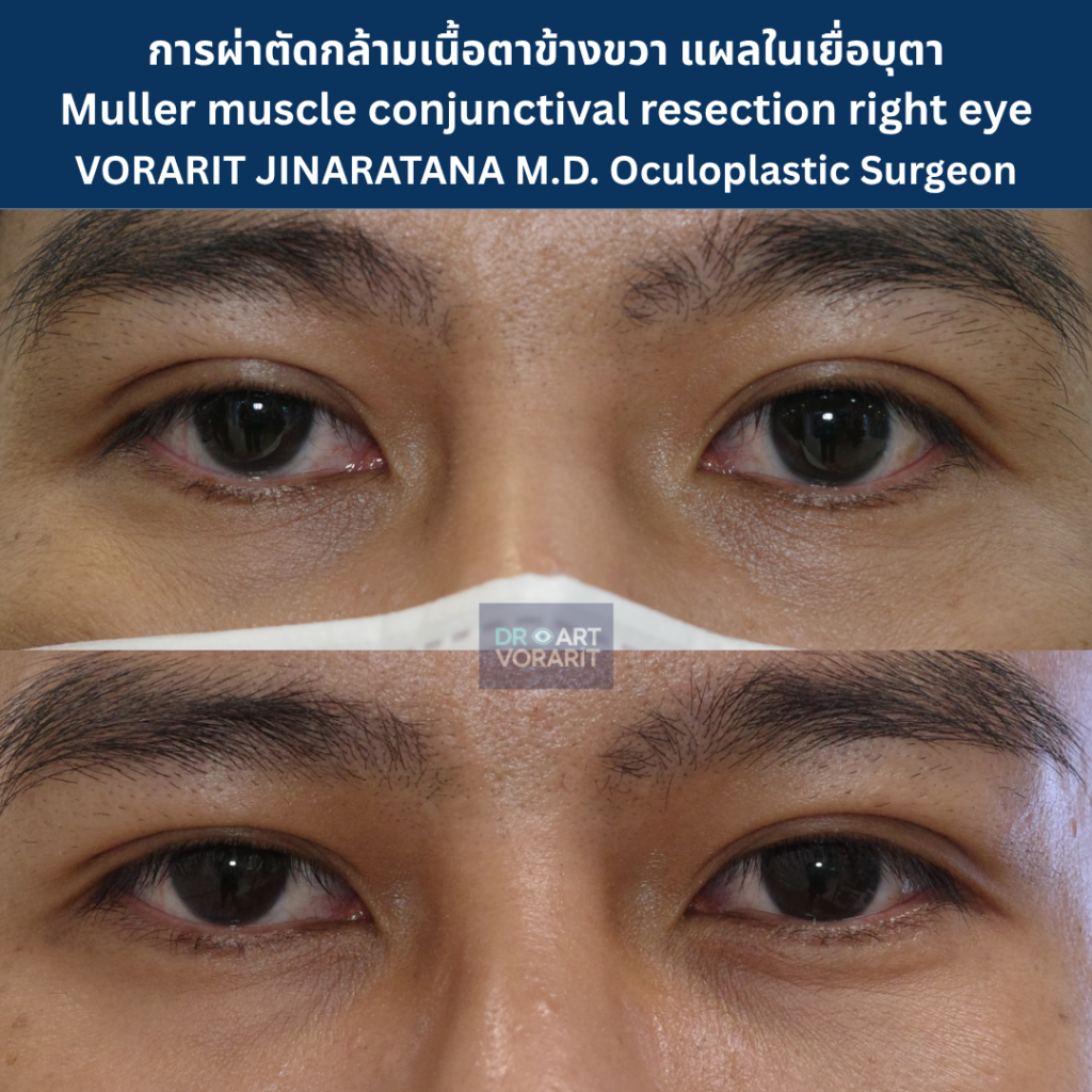 ผลการผ่าตัดกล้ามเนื้อตาอ่อนแรง แบบแผลในเยื่อบุตา (Muller Muscle Conjunctival Resection) ก่อนและหลัง โดย นพ.วรฤทธิ์ จินารัตน์ จักษุศัลยแพทย์ด้านตกแต่งและฟื้นฟู